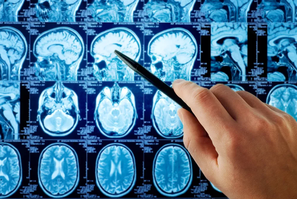 A person is holding a pen in front of an image of the brain.