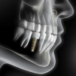 A picture of an x-ray image of the teeth and implant.