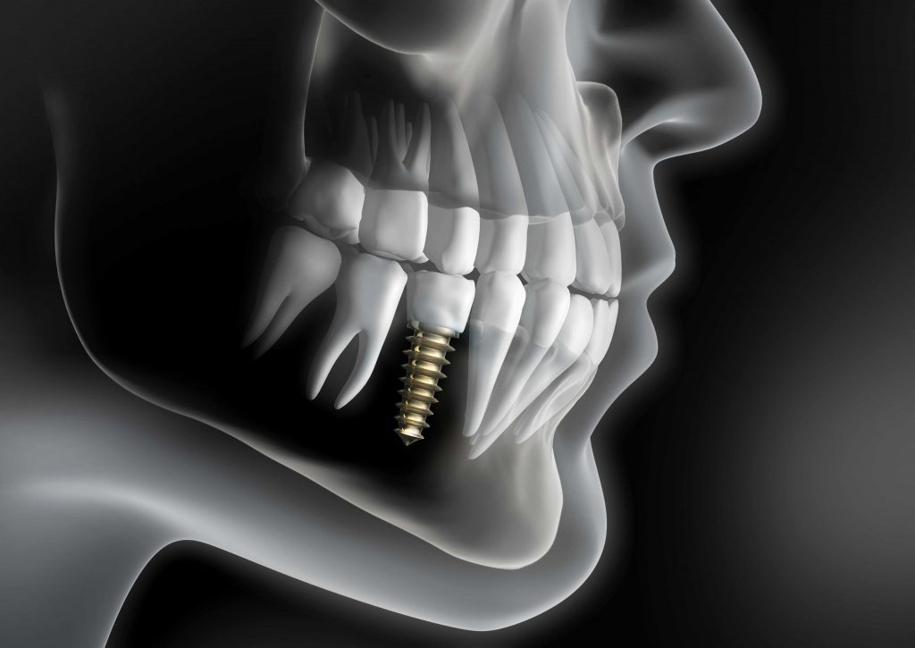 A picture of an x-ray image of the teeth and implant.